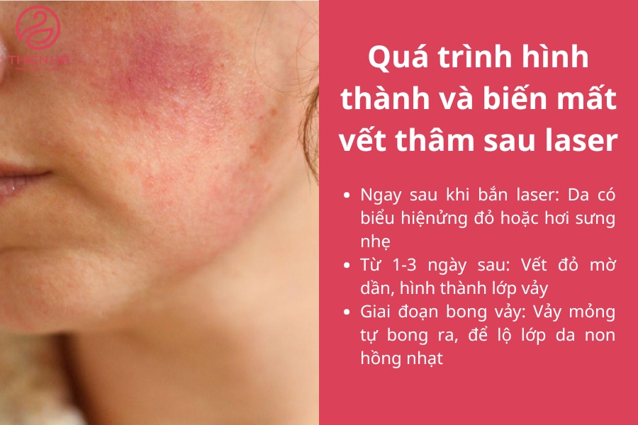 Việc hiểu rõ các giai đoạn này sẽ giúp bạn yên tâm hơn khi thấy những thay đổi trên làn da sau điều trị. Đừng quên chăm sóc đúng cách để làn da phục hồi nhanh chóng và đạt hiệu quả tối ưu.