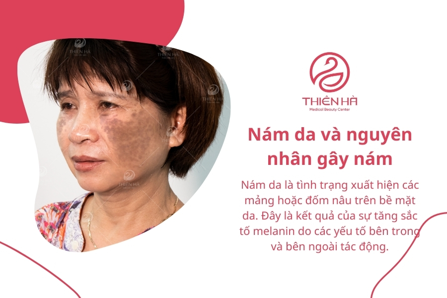 Hiểu rõ nguồn gốc của nám sẽ giúp bạn tìm được cách chăm sóc da bị nám phù hợp, hiệu quả.