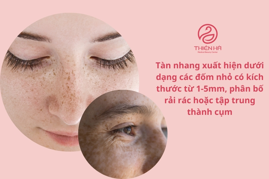 Tàn nhang khá dễ để nhận biết vì sự thay đổi rõ rệt của sắc tố da