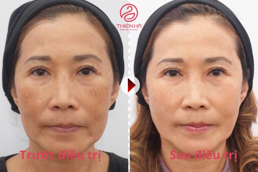 Cô Lan (35 tuổi, HN) chia sẻ: “ Cô bị tàn nhang lâu rồi nhưng bôi nhiều loại kem trị vẫn không khỏi, thậm chí thâm sạm ngày càng nhiều, đến Thiên Hà bắn laser trị tàn nhang là quyết định đúng đắn của cô vì chỉ sau 1 buổi da đã tươi sáng trở lại”