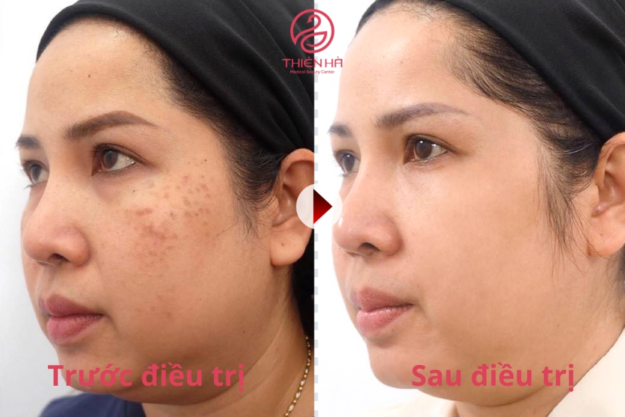 Chị Hồng (28 tuổi, HN) chia sẻ: “Do da không đều màu nên chị khá tự ti, chị cũng tốn nhiều thời gian điều trị tại nhà nhưng không hiệu quả, đến với Thiên Hà chỉ sau 1-2 buổi điều trị laser tàn nhang đã hoàn toàn biến mất.”