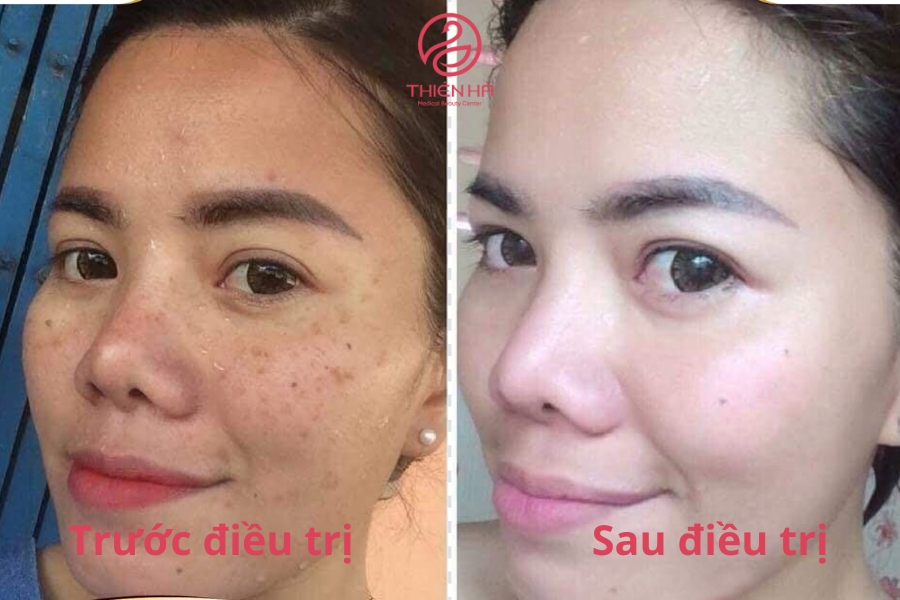Chị Trang (30 tuổi, HN): “Mình hơi tiếc vì không đến Thiên Hà sớm hơn, bắn laser trị tàn nhang rất nhanh, không tác dụng phụ, không mất thời gian chờ hiệu quả nhưng các phương pháp khác.”