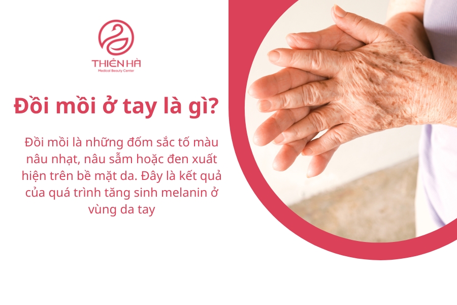 Đồi mồi xuất hiện ở vùng da tay chủ yếu do sự lão hóa khiến da mất đi sự bảo vệ