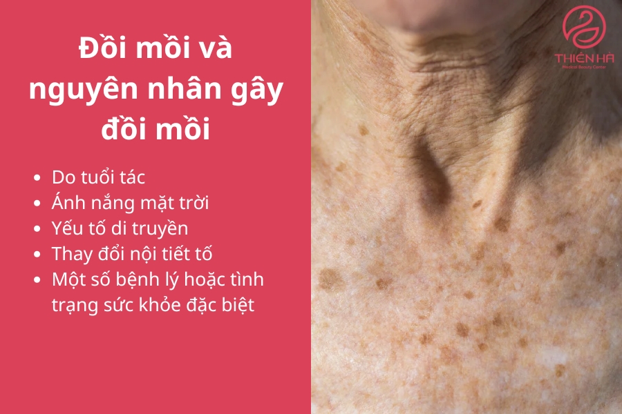 Hiểu rõ nguyên nhân gây đồi mồi sẽ giúp bạn có cách phòng ngừa và điều trị hiệu quả hơn, từ đó giữ gìn làn da khỏe mạnh và trẻ trung.