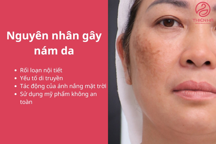 Nám da xuất phát từ nhiều nguyên nhân khác nhau 