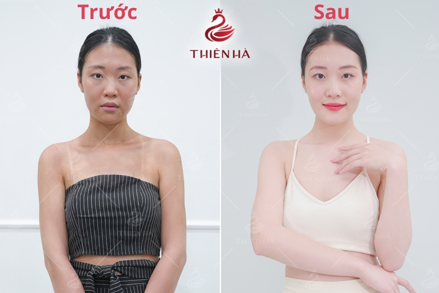 Hình ảnh khách hàng trước và sau khi tắm trắng tại Thiên Hà