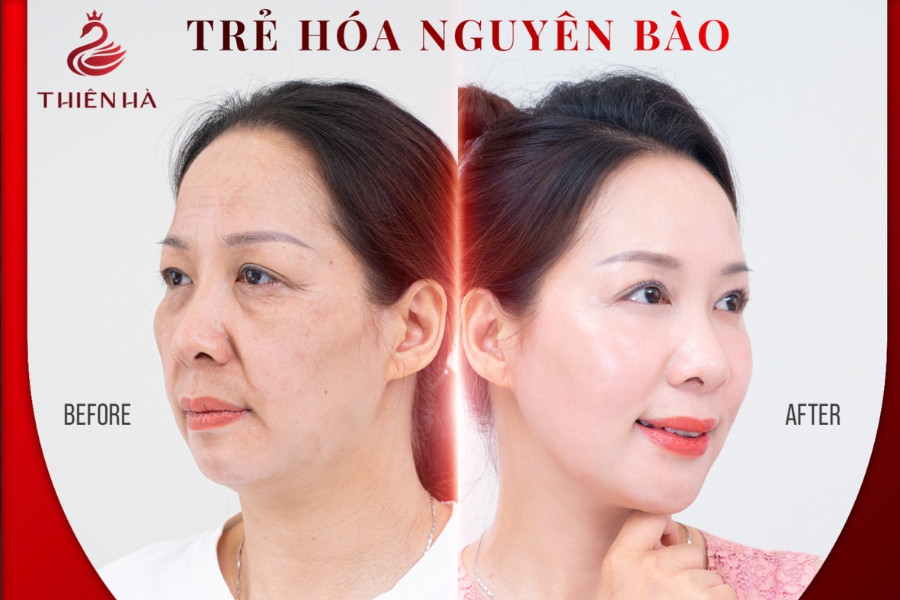 Hình ảnh khách hành trước và sau sử dụng dịch vụ trẻ hóa nguyên bào tại Thiên Hà
