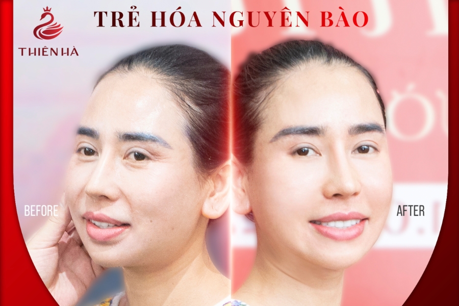 Hình ảnh khách hành trước và sau sử dụng dịch vụ trẻ hóa nguyên bào tại Thiên Hà