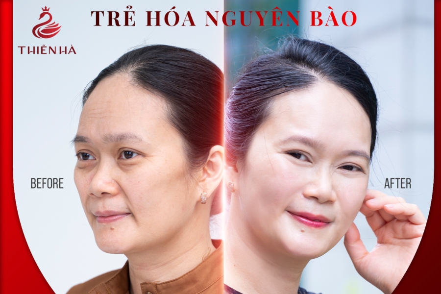 Hình ảnh khách hành trước và sau sử dụng dịch vụ trẻ hóa nguyên bào tại Thiên Hà