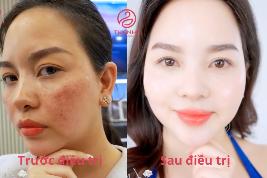 Hình ảnh khách hàng trước và sau khi điều trị nám, cải thiện lão hóa bằng laser tại Thiên Hà 