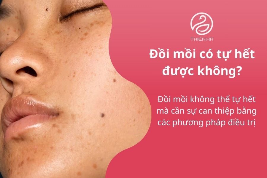 Nếu bạn băn khoăn về tình trạng da của mình, hãy tham khảo ý kiến bác sĩ da liễu để được tư vấn phương pháp phù hợp nhất.