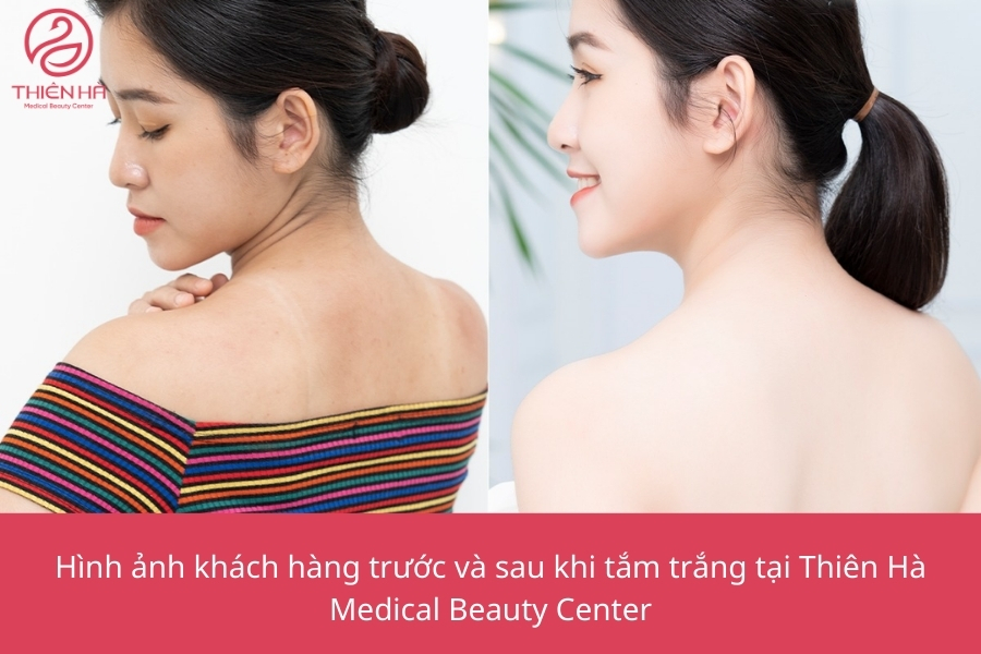 Công nghệ tắm trắng tại Thiên Hà đã giúp khách hàng thay đổi ngoạn mục chỉ sau vài buổi thực hiện 