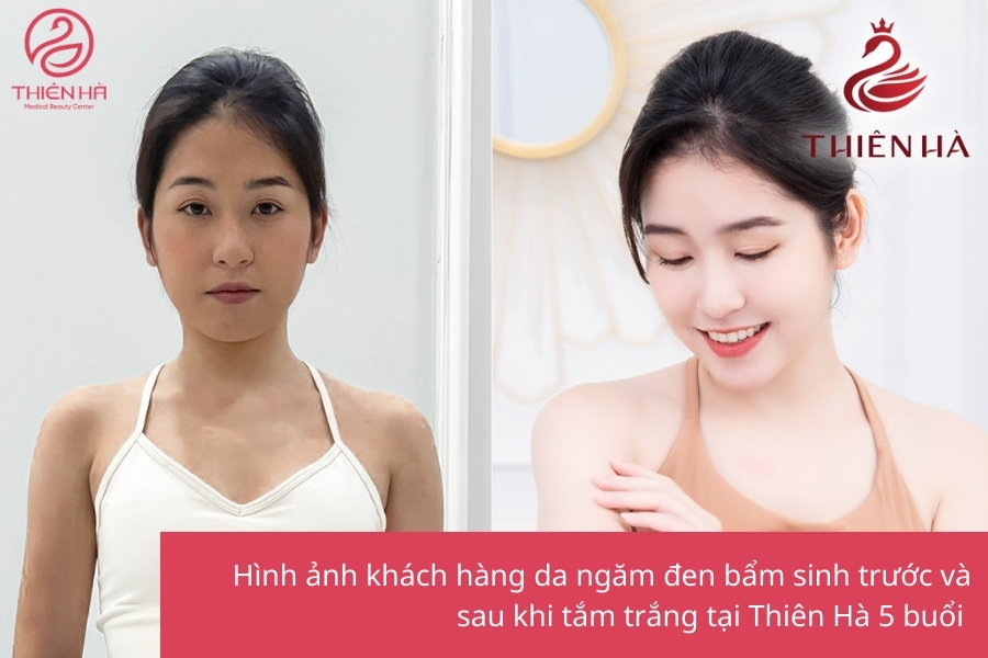Nếu bạn mong muốn bật tone nhanh chóng, trắng sáng rõ rệt ngay từ buổi đầu tiên và duy trì lâu dài, tắm trắng White Protenic Extra tại Thiên Hà chính là lựa chọn tối ưu nhất.