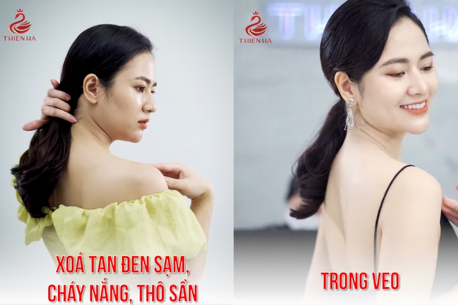 Hình ảnh khách hàng trước (bên trái) và sau (bên phải) khi tắm trắng công nghệ cao tại Thiên Hà