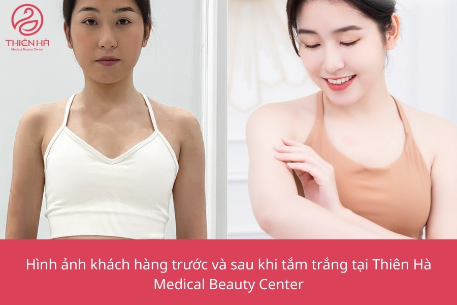 Hàng nghìn khách hàng đã trải nghiệm và hài lòng với làn da trắng hồng rạng rỡ tại Thiên Hà Medical Beauty Center. Đây là địa chỉ uy tín dành cho những ai mong muốn sở hữu làn da đẹp hoàn hảo một cách an toàn và bền vững.
