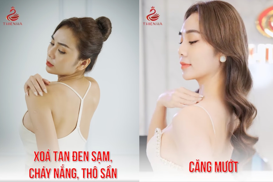 Hình ảnh khách hàng Kim Chi Hoàng trước (bên trái) và sau (bên phải) khi tắm trắng tại Thiên Hà