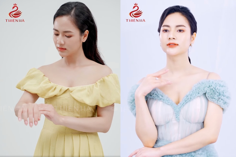 Diễn viên Việt Hoa trước (bên trái) và sau (bên phải) khi tắm trắng tại Thiên Hà