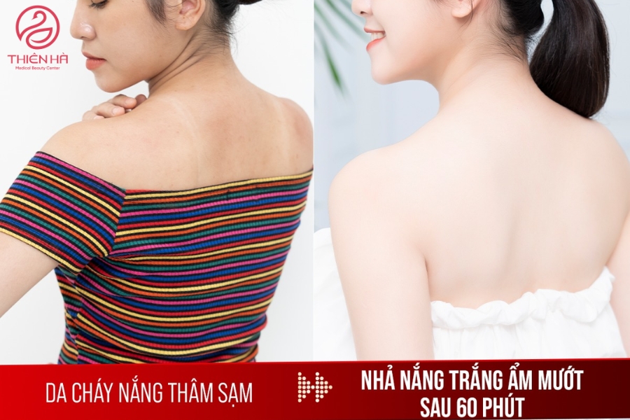 Hình ảnh khách hàng trước và sau khi tắm trắng công nghệ cao tại Thiên Hà.