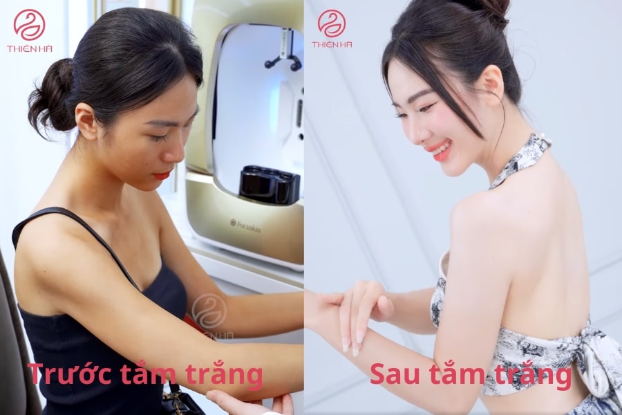 Hình ảnh khách hàng trước và sau khi tắm trắng White Proteinic Extra tại Thiên Hà