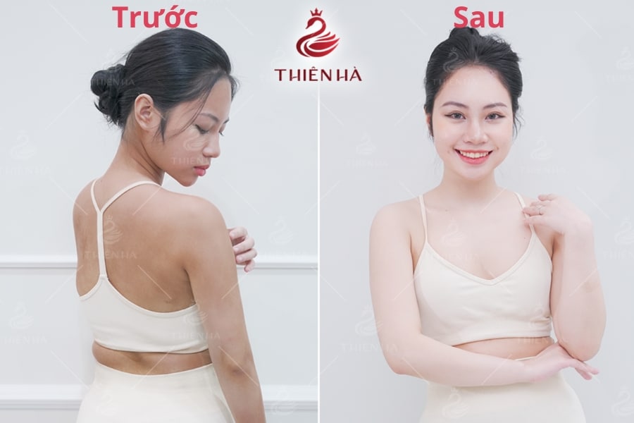 Hình ảnh khách hàng trước và sau khi tắm trắng phi thuyền tại Thiên Hà