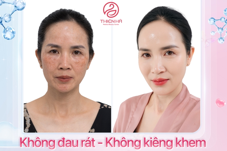 Với các phương pháp điều trị thâm da tiên tiến, Viện Thẩm Mỹ Thiên Hà là lựa chọn lý tưởng để giúp bạn lấy lại làn da sáng mịn và đều màu. 