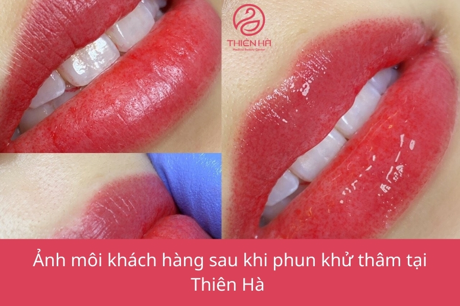 Thiên Hà sở hữu nhiều công nghệ hiện đại giúp khử thâm môi hiệu quả 