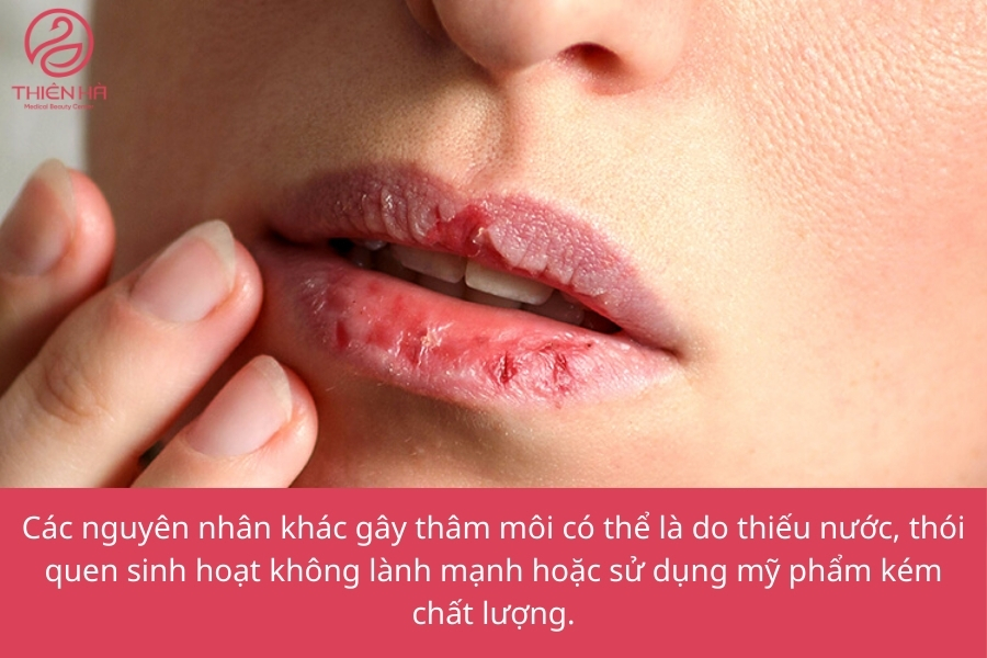 Môi thâm không chỉ do thiếu hụt dưỡng chất mà còn có thể do thiếu nước, thói quen sinh hoạt xấu và mỹ phẩm kém chất lượng. Để giữ đôi môi luôn mềm mịn, hồng hào, hãy duy trì chế độ ăn uống lành mạnh, chăm sóc môi đúng cách và lựa chọn mỹ phẩm an toàn. 