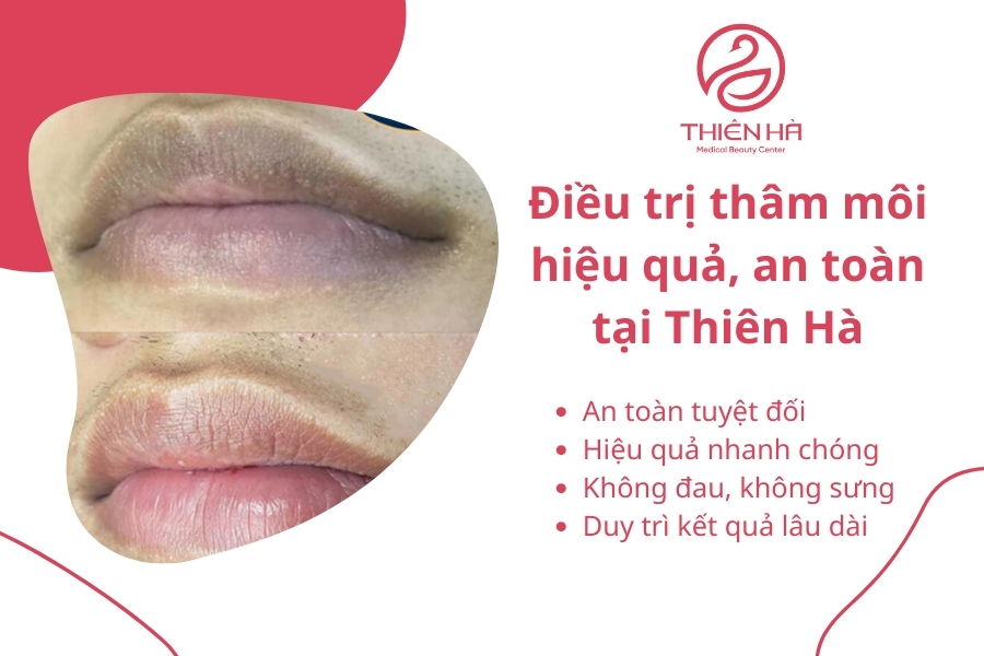 Thiên Hà sở hữu nhiều công nghệ trị thâm môi hiện đại 