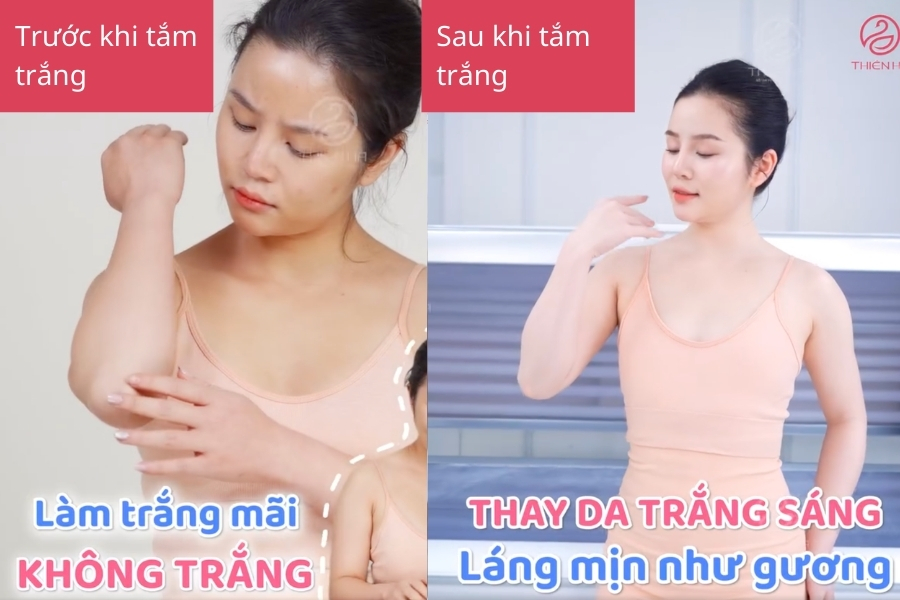 Hình ảnh khách hàng sau khi tắm trắng tại Thiên Hà
