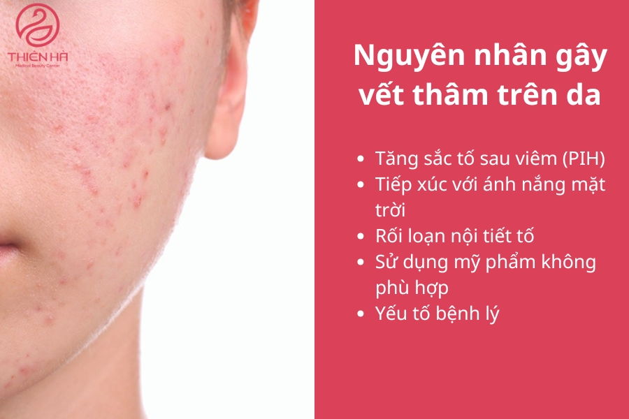 Nguyên nhân gây thâm da có thể do yếu tố nội sinh và ngoại sinh 