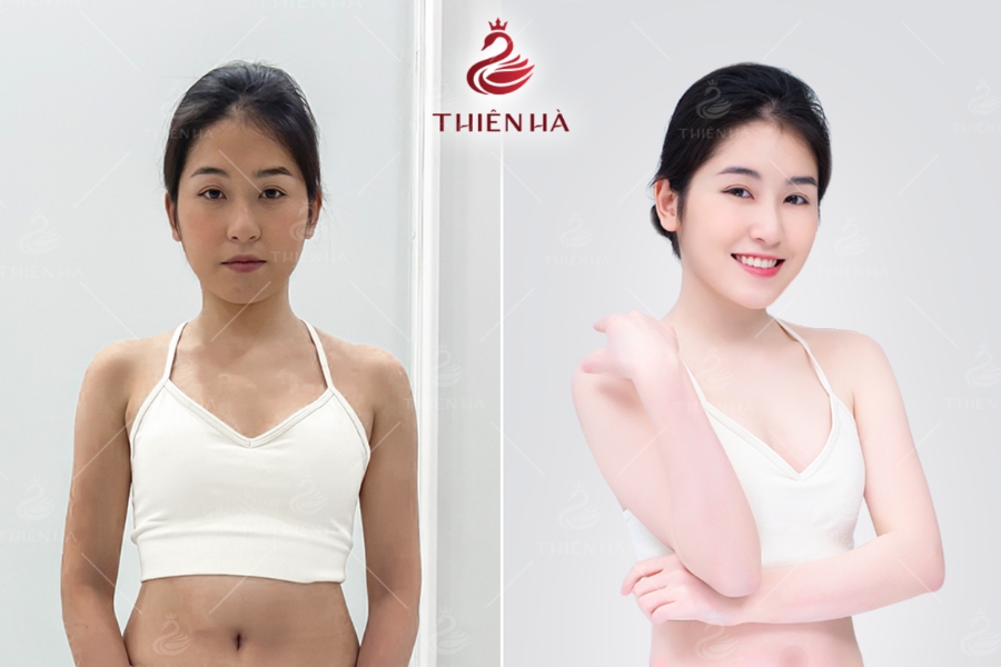 Với sự kết hợp giữa công nghệ tiên tiến và quy trình chuẩn y khoa, Viện Thẩm Mỹ Thiên Hà là lựa chọn lý tưởng cho những ai muốn trị thâm da an toàn, hiệu quả và lâu dài.