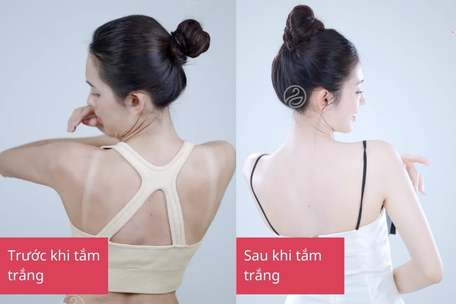 Thâm đỏ toàn thân có thể điều trị bằng phương pháp tắm trắng 
