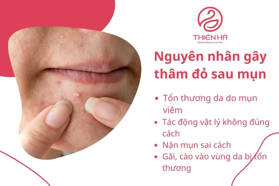 Thâm đỏ do mụn là lý do thường gặp nhất 