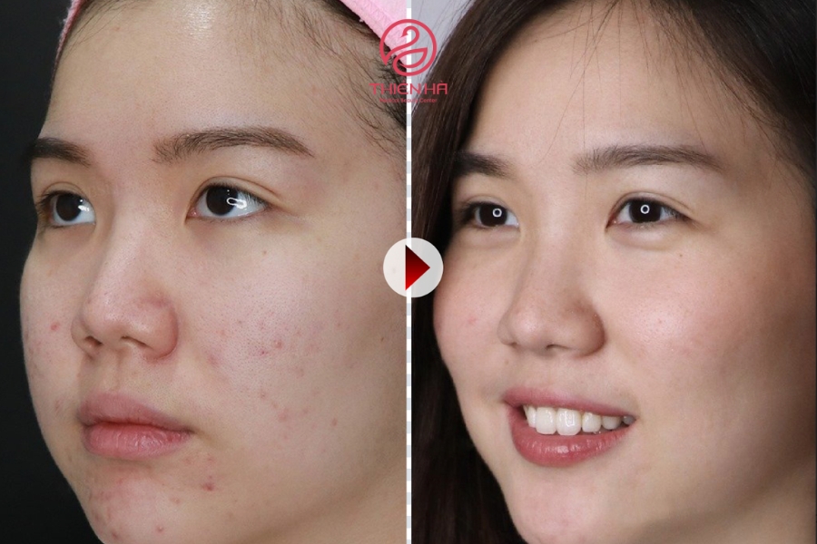 Hình ảnh khách hàng trước và sau khi trị thâm đỏ 