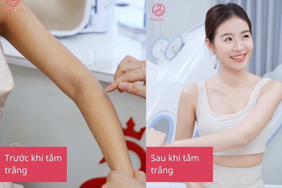 Tắm trắng là giải pháp loại bỏ thâm hiệu quả nhất 