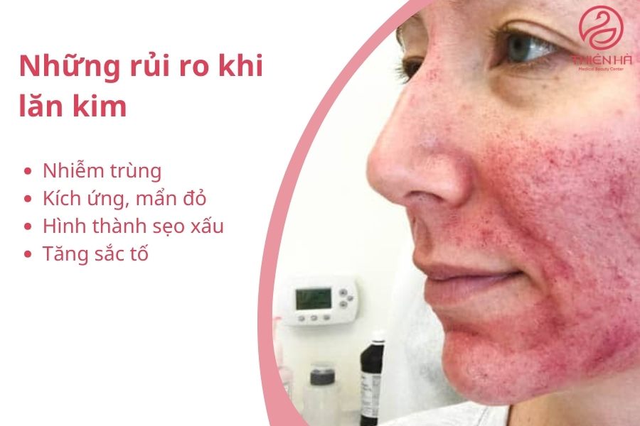 Những rủi ro khi lăn kim và cách phòng tránh