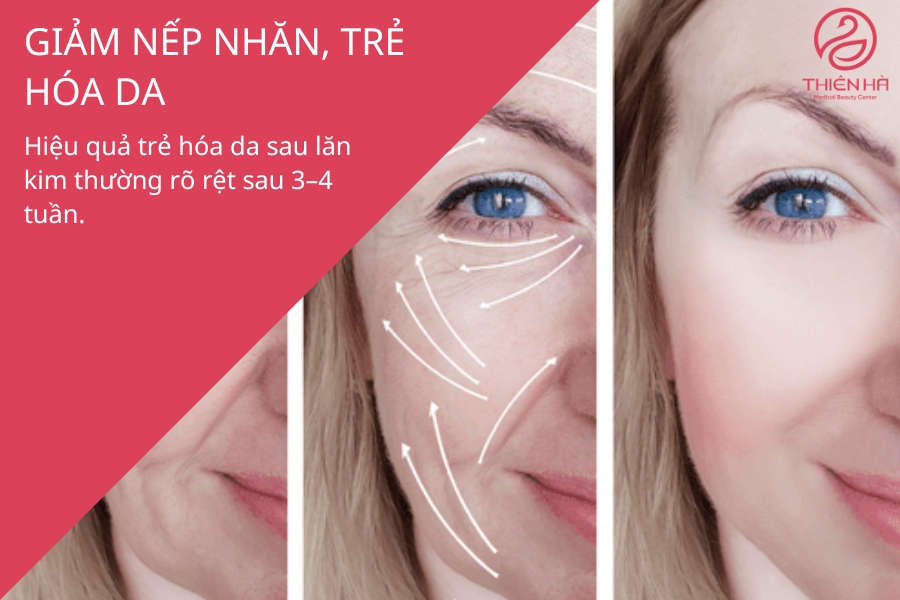Hình ảnh minh họa rõ sự cải thiện về độ đàn hồi và giảm nếp nhăn trước – sau liệu trình lăn kim, cho thấy hiệu quả trẻ hóa rõ rệt.