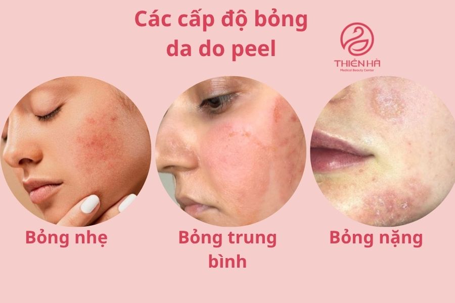 Các cấp độ bỏng da do peel (nhẹ, trung bình, nặng)