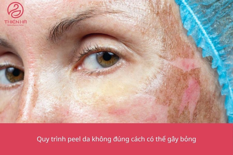 Hình ảnh minh họa quy trình peel da không đúng gây bỏng. Các chị em lưu ý