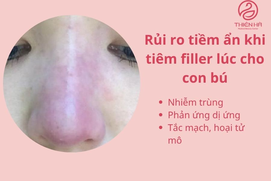 Biến chứng có thể xảy ra khi tiêm filler sưng, bầm tím