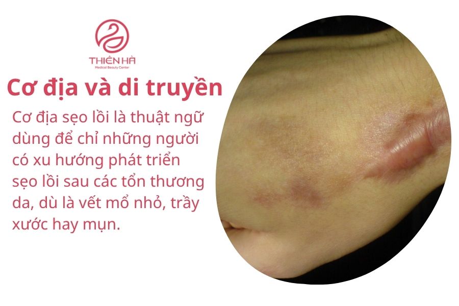 Cơ địa và di truyền 