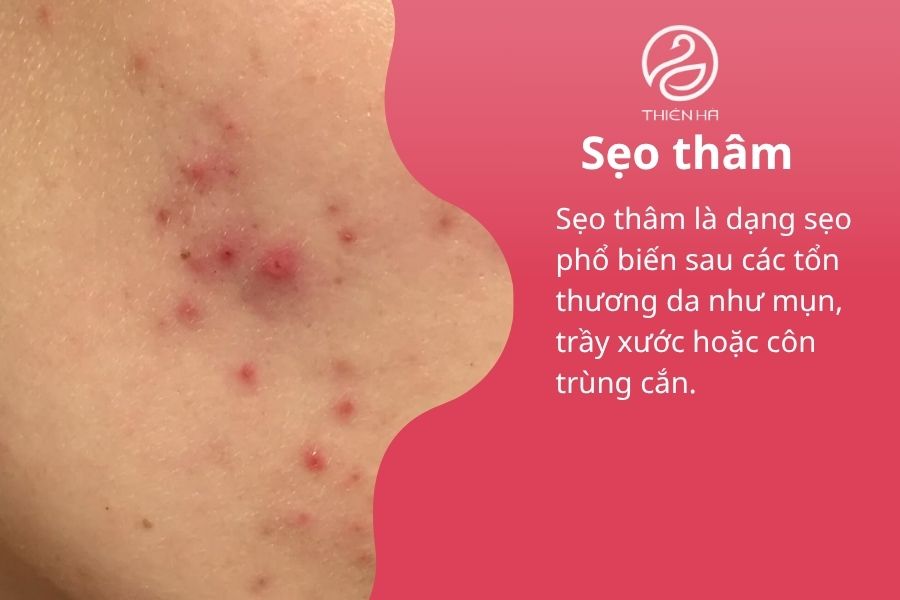 Hình ảnh sẹo thâm