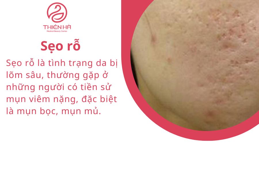 Hình ảnh sẹo rỗ
