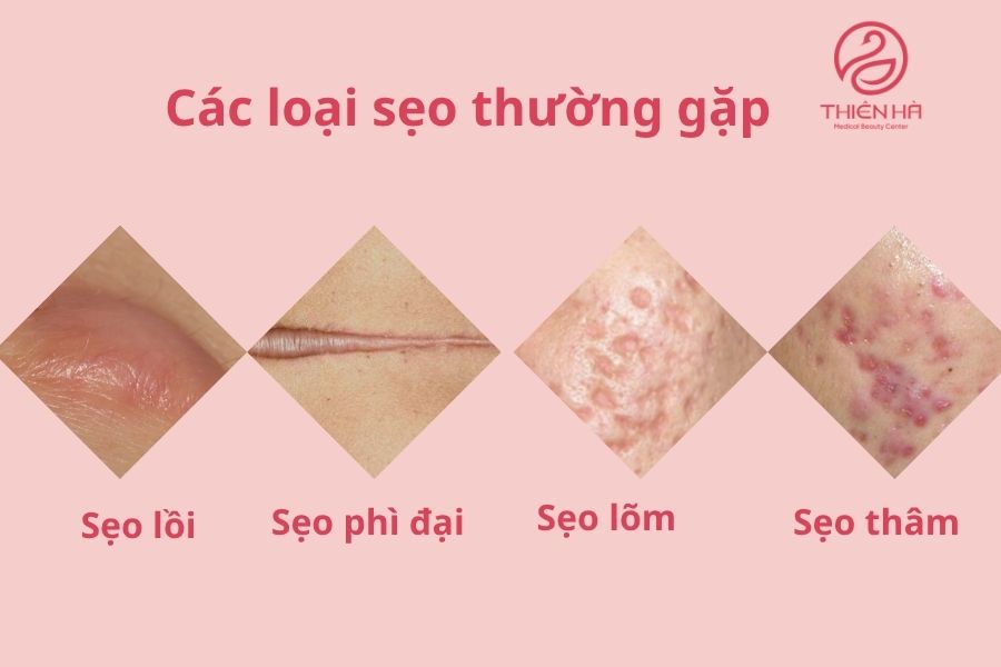 Các loại sẹo khác nhau