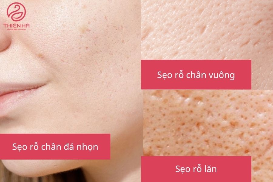 3 Loại sẹo rỗ thường gặp