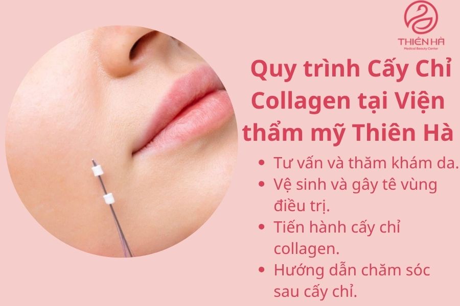 Quy trình Cấy Chỉ Collagen tại Viện thẩm mỹ Thiên Hà