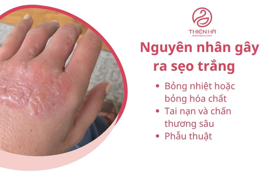 Nguyên nhân gây ra sẹo trắng