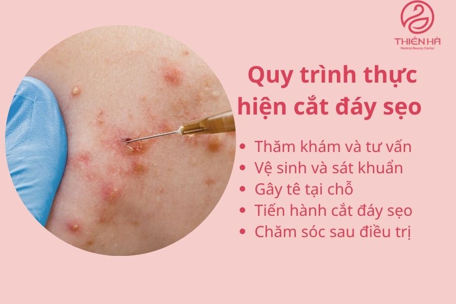 Quy trình thực hiện cắt đáy sẹo 