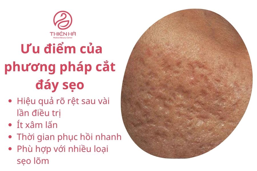 Ưu điểm của phương pháp cắt đáy sẹo