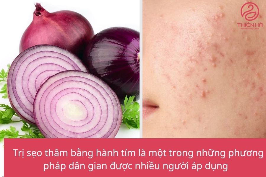 Trị sẹo thâm bằng hành tím 